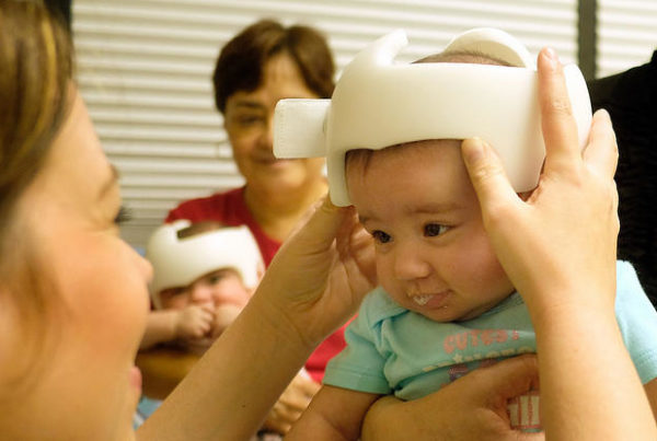 Baby Helmet Therapy on the Rise
