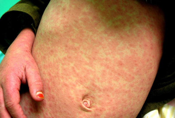 News Roundup: Five Texas Counties Affected By Measles Outbreak