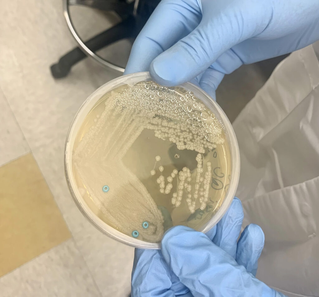 CDC warns of potentially deadly fungus and the growing threat of